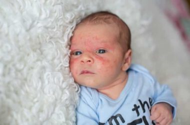 Newborn Acne