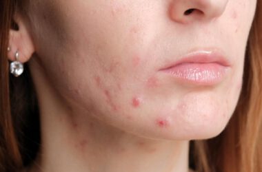 Acne During Pregnancy