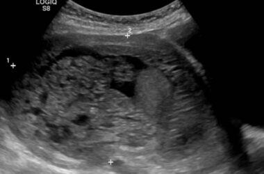 Things You Should Know About A Molar Pregnancy