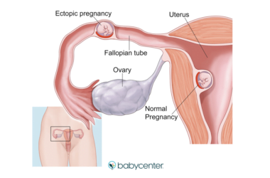 What You Need to Know About Tubal Pregnancy