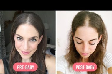What To Do About Hair Loss After Pregnancy